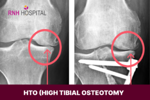 HTO-High Tibial Osteotomy | RNH Hospital