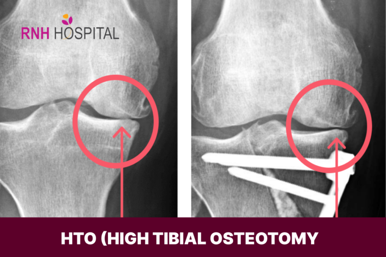 HTO-High Tibial Osteotomy | RNH Hospital