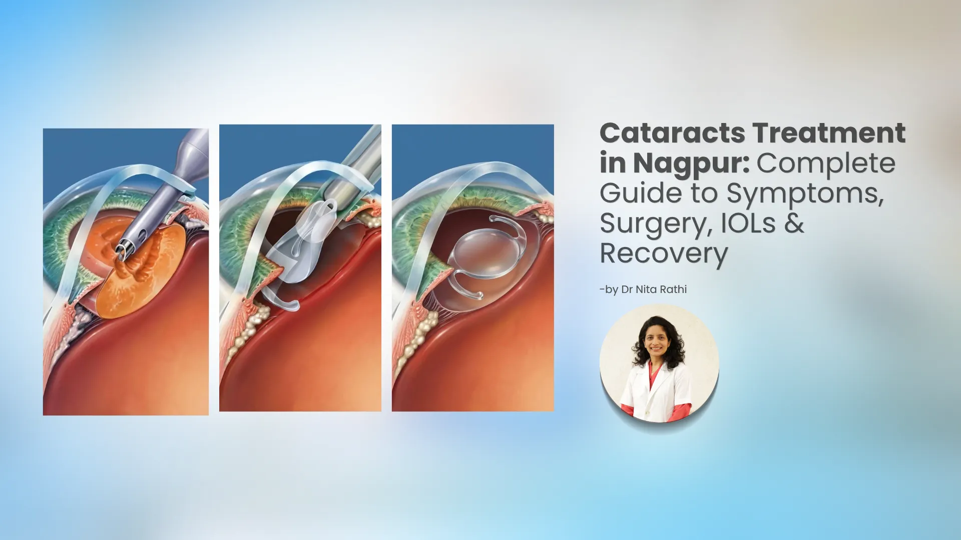 Cataracts treatment and cataract surgery for clearer vision in Nagpur